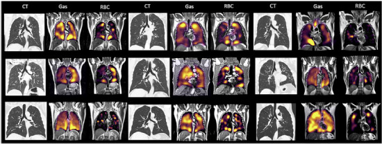 A montage of all patients scanned in this study showing CT, Gas, and RBC phase imaging in the coronal plane.