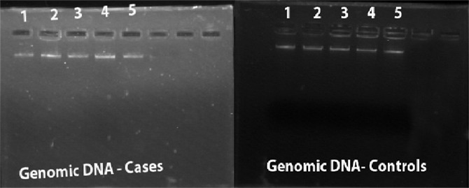 Fig 2: A. Genomic DNA extraction of Cases B. Genomic DNA extraction of Controls