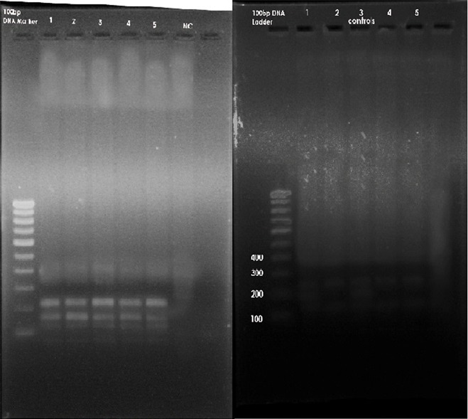 Fig 4: A. Restriction fragment length polymorphism of cases B. Restriction fragment length polymorphism of controls