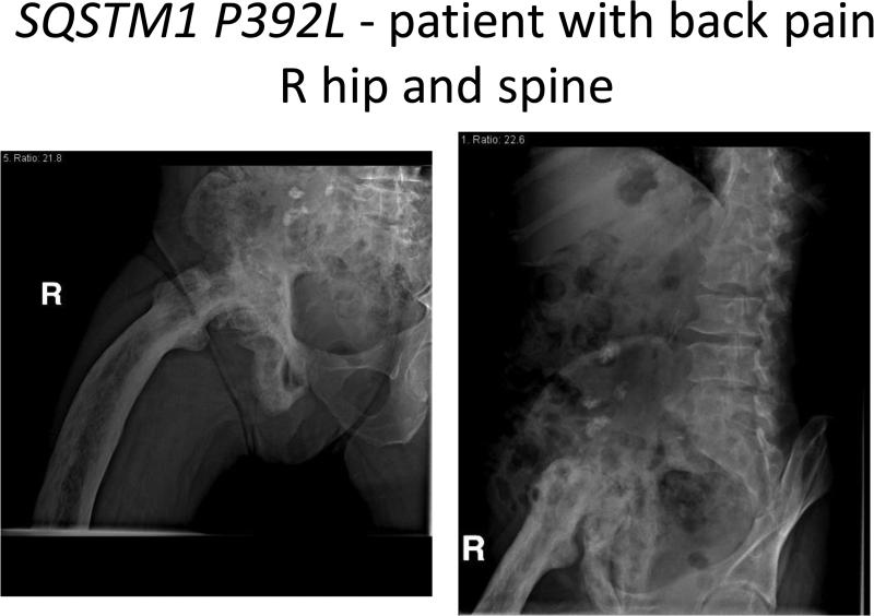 SQSTM1 P392L- Patient with back pain R hip and spine