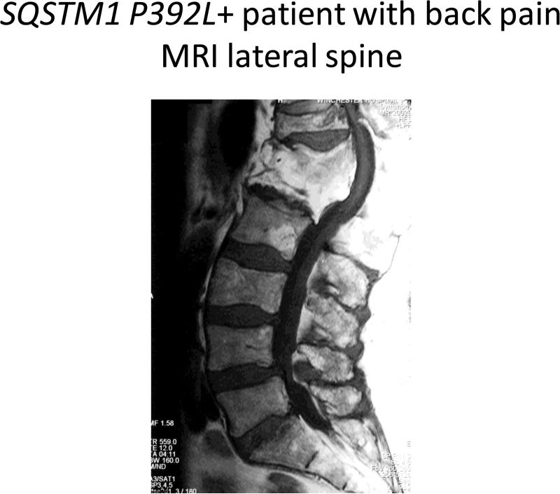 SQSTM1 P392L+ Patient with back pain MRI lateral spine