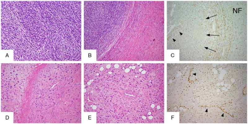 Loss of H3K27me3 Expression Is a Highly Sensitive Marker for Sporadic ...