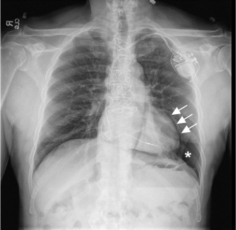 Pneumopericardium Develops After Pacemaker Implantation - PMC