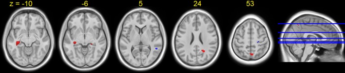 Increased Brain Activation For Dual Tasking With 70-days Head-down Bed 