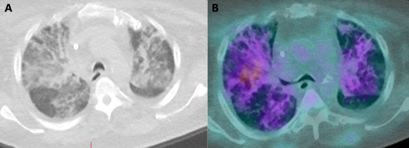 (A) Severe pulmonary infiltrates in a patient with recent COVID-19 infection. (B) There is rubidium uptake in these pulmonary infiltrates