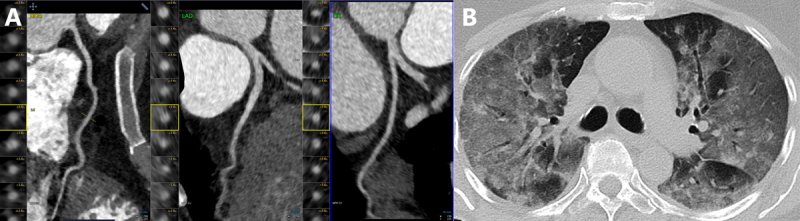 Coronary computed tomography (CT) angiography in a 34-year-old woman who presented with COVID-19 pneumonia