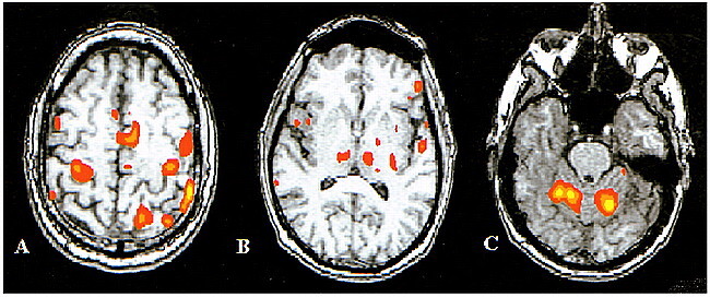 Functional MR Imaging Activation after Finger Tapping Has a Shorter ...
