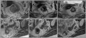 Images in a 56-year-old woman with locally advanced rectal cancer with
enlarged 1.3-cm left internal iliac lymph nodes containing heterogenous
signal intensity. Axial T2-weighted MR images at (A, B) baseline, (C, D) 8
weeks after total neoadjuvant therapy, and (E, F) 3.5 years after total
neoadjuvant therapy (surveillance). Post-total neoadjuvant therapy images
show near-complete response within the primary tumor (arrow in C) and only
slight regression of the pelvic node measuring 1.3 cm (arrow in D).
Endoscopic biopsy of the tumor bed at this assessment timepoint was negative
for malignancy. The patient opted for nonsurgical management and remains
free of tumor regrowth at 3.5-year follow-up (arrow in E). The left internal
iliac lymph node shows regression with decreased size and mixed T2-weighted
signal changes measuring 0.8 cm (arrow in F).