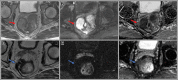 Images in a 58-year-old man with rectal adenocarcinoma. Baseline (A)
axial T2-weighted MRI scan, (B) axial diffusion-weighted image (b value, 800
sec/mm2), and (C) apparent diffusion coefficient map show a large rectal
mass with an extraluminal component on the right side contacting the
mesorectal fascia (red arrow) with restricted diffusion. Axial (D)
T2-weighted MRI scan, (E) axial diffusion-weighted image (b value, 800
sec/mm2), and (F) apparent diffusion coefficient image at 4 weeks after
completion of total neoadjuvant therapy show a scar in the tumor bed
extending to the mesorectal fascia and minimal residual restricted diffusion
(blue arrow), consistent with near-complete response. The patient underwent
low anterior resection. Final histology revealed a few foci of residual
cancer and no involvement of the mesorectal fascia.