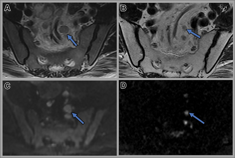 Images in a 58-year-old man with rectal adenocarcinoma. (A, C) Axial T2-weighted MRI scans and (B, D) axial diffusion-weighted (b value, 800 sec/mm2) images at baseline (A, B) and 4 weeks after completion of total neoadjuvant therapy (C, D). Baseline images shows several superior rectal lymph nodes with intermediate signal intensity measuring up to 1.0 cm in short-axis dimension (arrow in A). Post-total neoadjuvant therapy image shows decreased size of the lymph nodes with uniform signal intensity measuring up to 0.5 cm in the short-axis dimension (arrow in B). Nodes are well seen on diffusion-weighted images, which helps in detection of the nodes (arrows in B and D). The patient underwent low anterior resection. Final histologic examination showed no evidence of metastasis in the lymph nodes.