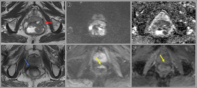 Images in a 65-year-old man with a low rectal tumor with anterior perforation extending to the anterior mesorectal fascia (red arrow). (A, D) Axial T2-weighted MRI scans, (B, E) axial diffusion-weighted images (b value, 800 sec/mm2), and (C, F) apparent diffusion coefficient maps at baseline (A–C) and 12 weeks after completion of total neoadjuvant therapy (D–F). Post-total neoadjuvant therapy images show decreased size of the tumor with new scar (blue arrow) and some residual restricted diffusion (yellow arrow), consistent with near-complete response. The patient opted for nonsurgical management and remains free of tumor regrowth at 3.5 years of surveillance.