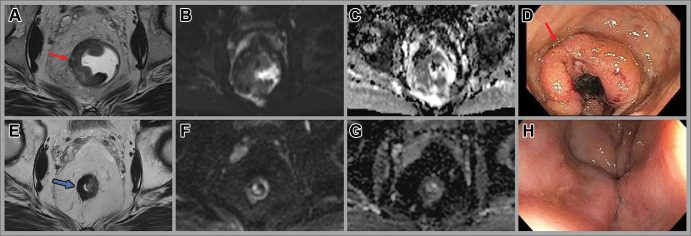 Images in a 46-year-old man with locally advanced rectal cancer. Axial (A) T2-weighted MRI scan, (B) axial diffusion-weighted image, and (C) apparent diffusion coefficient map at baseline show a tumor with intermediate T2-weighted signal intensity (arrow in A), concordant with (D) the endoscopic findings of a fungating and ulcerating rectal mass (arrow). Note the rectal gel in the lumen masking the high signal intensity on B. (E) Posttotal neoadjuvant therapy image obtained 8 weeks after completion of therapy shows T2-weighted dark signal intensity in the tumor bed (arrow) and (F, G) minimal restricted diffusion. (H) No residual tumor was seen at endoscopy, consistent with complete response.