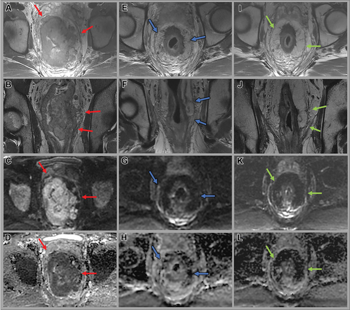 Images in a 53-year-old man with bulky middle to upper rectal adenocarcinoma involving the mesorectal fascia. (A, E, I) Axial and (B, F, J) coronal oblique T2-weighted MRI scans, (C, G, K) axial diffusion-weighted images (b value = 800 sec/mm2), and (D, H, L) apparent diffusion coefficient maps through the mid rectum at baseline (A–D), 12 weeks after total neoadjuvant therapy (E–H), and 14 months surveillance after total neoadjuvant therapy while the patient was on a watch-andwait (W&W) strategy (I–L). Baseline images show the primary rectal tumor with multifocal involvement of the mesorectal fascia (red arrows). Post-total neoadjuvant therapy images at 12 weeks show some T2-weighted mixed dark and intermediate signal intensity within the tumor and desmoplastic reactions extending up to the mesorectal fascia (blue arrows). Endoscopy images show intense inflammation (images not shown). Surveillance images at 14 months while the patient was on the W&W strategy show darker T2-weighted dark signal intensity in the scar, no tumor regrowth, clear mesorectal fascia (green arrows), and continued absence of restricted diffusion.