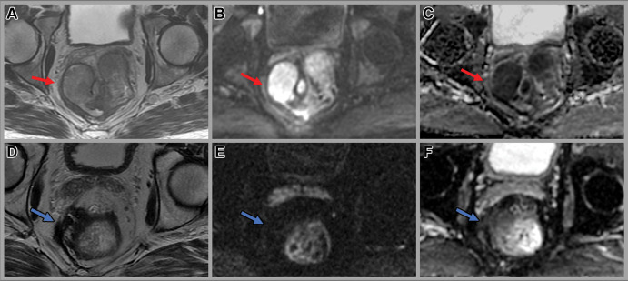 Images in a 58-year-old man with rectal adenocarcinoma. Baseline (A) axial T2-weighted MRI scan, (B) axial diffusion-weighted image (b value, 800 sec/mm2), and (C) apparent diffusion coefficient map show a large rectal mass with an extraluminal component on the right side contacting the mesorectal fascia (red arrow) with restricted diffusion. Axial (D) T2-weighted MRI scan, (E) axial diffusion-weighted image (b value, 800 sec/mm2), and (F) apparent diffusion coefficient image at 4 weeks after completion of total neoadjuvant therapy show a scar in the tumor bed extending to the mesorectal fascia and minimal residual restricted diffusion (blue arrow), consistent with near-complete response. The patient underwent low anterior resection. Final histology revealed a few foci of residual cancer and no involvement of the mesorectal fascia.