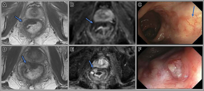 Images in a 68-year-old man with locally advanced rectal cancer. Axial (A) T2-weighted MRI scan and (B) diffusion-weighted image obtained 12 weeks after total neoadjuvant therapy show a T2-weighted dark scar (arrow). (C) Endoscopy 8 months after total neoadjuvant therapy shows radiation-related telangiectatic changes (arrow), with no evidence of tumor. (D) Surveillance scans obtained 12 months after total neoadjuvant therapy show higher intermediate signal intensity tumor regrowth (arrow in D), with restricted diffusion (arrow in E). (F) Endoscopy at 12-month follow-up shows a 0.5-cm ulcerated nodule in the tumor bed, consistent with tumor regrowth.