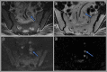 Images in a 58-year-old man with rectal adenocarcinoma. (A, C) Axial
T2-weighted MRI scans and (B, D) axial diffusion-weighted (b value, 800
sec/mm2) images at baseline (A, B) and 4 weeks after completion of total
neoadjuvant therapy (C, D). Baseline images shows several superior rectal
lymph nodes with intermediate signal intensity measuring up to 1.0 cm in
short-axis dimension (arrow in A). Post-total neoadjuvant therapy image
shows decreased size of the lymph nodes with uniform signal intensity
measuring up to 0.5 cm in the short-axis dimension (arrow in B). Nodes are
well seen on diffusion-weighted images, which helps in detection of the
nodes (arrows in B and D). The patient underwent low anterior resection.
Final histologic examination showed no evidence of metastasis in the lymph
nodes.