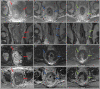 Images in a 53-year-old man with bulky middle to upper rectal
adenocarcinoma involving the mesorectal fascia. (A, E, I) Axial and (B, F,
J) coronal oblique T2-weighted MRI scans, (C, G, K) axial diffusion-weighted
images (b value = 800 sec/mm2), and (D, H, L) apparent diffusion coefficient
maps through the mid rectum at baseline (A–D), 12 weeks after total
neoadjuvant therapy (E–H), and 14 months surveillance after total
neoadjuvant therapy while the patient was on a watch-andwait (W&W)
strategy (I–L). Baseline images show the primary rectal tumor with
multifocal involvement of the mesorectal fascia (red arrows). Post-total
neoadjuvant therapy images at 12 weeks show some T2-weighted mixed dark and
intermediate signal intensity within the tumor and desmoplastic reactions
extending up to the mesorectal fascia (blue arrows). Endoscopy images show
intense inflammation (images not shown). Surveillance images at 14 months
while the patient was on the W&W strategy show darker T2-weighted
dark signal intensity in the scar, no tumor regrowth, clear mesorectal
fascia (green arrows), and continued absence of restricted
diffusion.