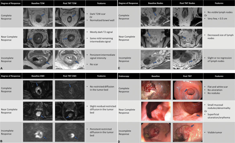 (A) Complete, near complete, and incomplete response within the primary tumor (arrows) on axial T2-weighted (T2W) MRI scans at restaging performed after completion of total neoadjuvant therapy. (B) Complete, near complete, and incomplete response (arrows) within the primary tumor on axial diffusion-weighted images at restaging performed after completion of total neoadjuvant therapy (TNT) (C) Complete, near complete, and incomplete response (arrows) within the lymph nodes on axial T2-weighted MRI scans at restaging performed after completion of total neoadjuvant therapy (TNT). (D) Endoscopy images depicting complete, near complete, and incomplete response (arrows) within the primary tumor obtained after completion of TNT.