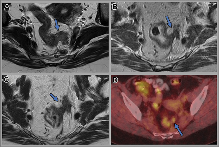 Images in a 53-year-old woman with locally advanced upper rectal tumor. Axial T2-weighted MRI scans (A) at baseline, (B) 12 weeks after total neoadjuvant therapy, and (C) 12 months after total neoadjuvant therapy (surveillance). (D) Subsequent fused axial fluorine 18 (18F) fluorodeoxyglucose (FDG) PET/CT image. In A, intermediate T2-weighted signal intensity left lateral extramural vascular invasion (arrow) is seen. In B, partial regression of extramural vascular invasion (arrow) is shown. No residual tumor was seen at endoscopy. In C, tumor regrowth within the extramural vascular invasion site (arrow) is visible. Moderately intense 18F-FDG uptake (maximum standard uptake value, 4.1) is seen within the extramural vascular invasion (arrow) on D.