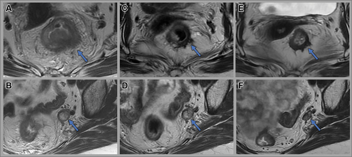 Images in a 56-year-old woman with locally advanced rectal cancer with enlarged 1.3-cm left internal iliac lymph nodes containing heterogenous signal intensity. Axial T2-weighted MR images at (A, B) baseline, (C, D) 8 weeks after total neoadjuvant therapy, and (E, F) 3.5 years after total neoadjuvant therapy (surveillance). Post-total neoadjuvant therapy images show near-complete response within the primary tumor (arrow in C) and only slight regression of the pelvic node measuring 1.3 cm (arrow in D). Endoscopic biopsy of the tumor bed at this assessment timepoint was negative for malignancy. The patient opted for nonsurgical management and remains free of tumor regrowth at 3.5-year follow-up (arrow in E). The left internal iliac lymph node shows regression with decreased size and mixed T2-weighted signal changes measuring 0.8 cm (arrow in F).