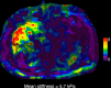 Example of the MR elastography (MRE) plus Fibrosis-4 (FIB-4) (MEFIB)
sequential approach used to rule in or rule out significant fibrosis in a
66-year-old man with clinical suspicion of significant fibrosis. A FIB-4
value of 5.15 (higher than the ≥1.6 threshold) computed from age,
aspartate aminotransferase, alanine transaminase, and platelet count
justified proceeding to MRE, which revealed a mean stiffness of 5.7 kPa. The
axial elastogram represents a stiffness map expressed in kilopascals, on a
scale from 0 to 8 kPa, where low stiffness is represented in purple and high
stiffness in red, with a confidence mask overlaid (hatching). The
combination of a FIB-4 value of 1.6 or greater and an MRE-derived liver
stiffness of 3.3 kPa or greater has a high positive predictive value to rule
in significant fibrosis (≥F2). A liver biopsy performed in a research
setting confirmed cirrhosis (F4) related to metabolic
dysfunction–associated steatohepatitis.
