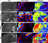 Example axial T2-weighted (T2 W) MRI scans (left), wave images
(middle), and elastograms (right) illustrating the contexts of use of MR
elastography in patients with advanced fibrosis with different liver disease
etiologies. The reported stiffness threshold for fibrosis stages may vary
based on differences in study population and reference standard (ie,
histologic examination) sampling variability. Based on consensus
interpretation of multiple studies and meta-analysis, and to simplify the
interpretation of MR elastographic stiffness in clinical care, a common set
of simple thresholds is recommended regardless of the underlying etiology of
chronic liver disease: 3.0 kPa for stage F1 or higher, 3.5 kPa for stage F2
or higher, 4.0 kPa for stage F3 or higher, and 5.0 kPa for stage F4. HBV =
hepatitis B virus infection, HCV = hepatitis C virus infection, MASH =
metabolic dysfunction–associated steatohepatitis, PSC = primary
sclerosing cholangitis.