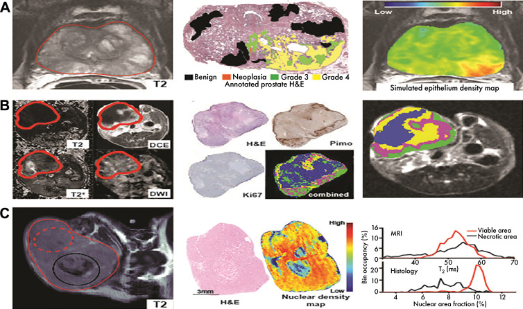 Coregistered histologic findings provide biological insight into image features. H&E = hematoxylin-eosin. A, McGarry et al (additional data provided by authors) developed model using multiparametric MRI information (left), trained on coregistered annotated hematoxylin-eosin–stained slides (middle) to model prostate epithelium density (right), relevant for tumor staging. B, Jardim-Perassi used multiparametric MRI (left), coregistered with histologic maps of viability, proliferation, and hypoxia (middle) to understand biological meaning of imaging habitats (right). DCE = dynamic contrast enhanced, DWI = diffusion-weighted imaging, Pimo = pimonidazole. C, Tomaszewski et al proposed T2-weighted MRI (left) histogram biomarker of radiation therapy response and used coregistered histologically derived nuclear density maps (middle) to demonstrate source of observed imaging changes through similarities in histogram features (right). Source.—References 79, 80, 89.