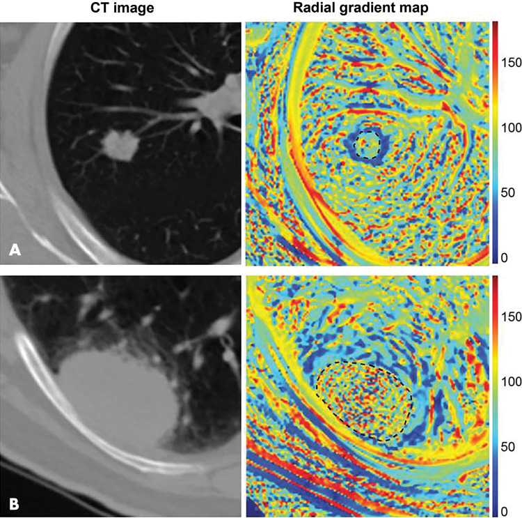 Radiomics can quantify visual tumor characteristics. CT images (left) of lung cancer lesions from two patients (A and B) were used by Tunali et al to calculate radial gradient maps (right) that describe tumor edge interface (tumor outlined in black dotted line). Quantification of simple mean and standard deviation of map in peritumoral region is associated with survival and correlates to qualitative semantic descriptors of tumor edge, such as border definition. Source.—Reference 14.