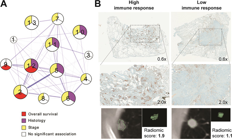 Associations between radiomic and pathway data can be explored histologically. A, Diagram depicts analysis of correlations between pathway enrichment and radiomic features presented by Grossman et al. Multiple clusters (numbers 1–13) describe relationships between distinct biological processes and image information. Further correlation of relevant radiomic features and immunohistochemical staining (nuclear CD3 expression) was performed to validate findings and to provide link to understand interaction between genetics and imaging characteristics of tumor. B, Example tumors with strong immune response and/or high radiomic score (left) and low immune response and/or radiomic score (right) are shown. Source.—Reference 43.