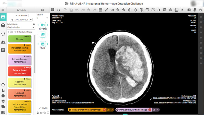 A complex multicompartmental cerebral hemorrhage on a single axial CT image displayed using the annotation tool in a single portal window. Hemorrhage labels (left column) relevant to the image display on the bottom of the image once selected. ASNR = American Society of Neuroradiology, RSNA =Radiological Society of North America.