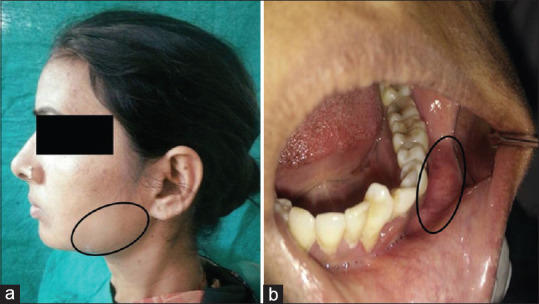 Odontogenic myxoma of the mandible: An update on pathogenesis and ...