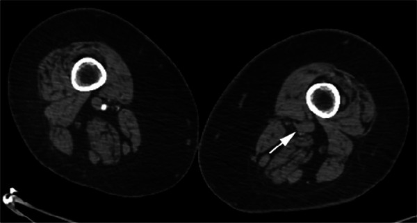 CTA images from a 63-year-old woman with COVID-19. Images through the (a) distal abdominal aorta, (b) proximal common iliac arteries, (c) external iliac arteries, (d) popliteal arteries, and (e) anterior tibial, posterior tibial, and peroneal arteries demonstrate lack of contrast opacification on the left (arrows). Hyperdensity along the periphery of the vessels in a and b corresponds to contrast rather than calcium. Note that the arrows in e point to the expected location of the vessels. (f) Oblique coronal reformatted CT image demonstrates clot at the aortic bifurcation (arrow).