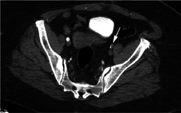 CTA images from a 63-year-old woman with COVID-19. Images through the (a) distal abdominal aorta, (b) proximal common iliac arteries, (c) external iliac arteries, (d) popliteal arteries, and (e) anterior tibial, posterior tibial, and peroneal arteries demonstrate lack of contrast opacification on the left (arrows). Hyperdensity along the periphery of the vessels in a and b corresponds to contrast rather than calcium. Note that the arrows in e point to the expected location of the vessels. (f) Oblique coronal reformatted CT image demonstrates clot at the aortic bifurcation (arrow).