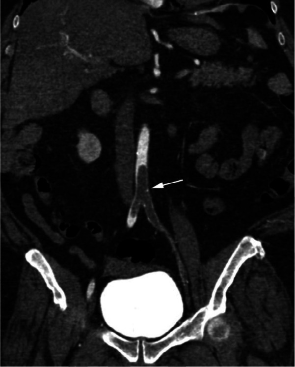 CTA images from a 63-year-old woman with COVID-19. Images through the (a) distal abdominal aorta, (b) proximal common iliac arteries, (c) external iliac arteries, (d) popliteal arteries, and (e) anterior tibial, posterior tibial, and peroneal arteries demonstrate lack of contrast opacification on the left (arrows). Hyperdensity along the periphery of the vessels in a and b corresponds to contrast rather than calcium. Note that the arrows in e point to the expected location of the vessels. (f) Oblique coronal reformatted CT image demonstrates clot at the aortic bifurcation (arrow).