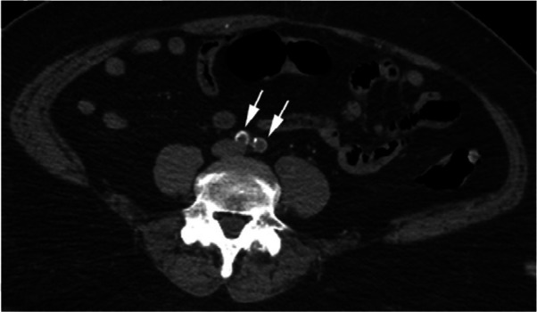 CTA images from a 63-year-old woman with COVID-19. Images through the (a) distal abdominal aorta, (b) proximal common iliac arteries, (c) external iliac arteries, (d) popliteal arteries, and (e) anterior tibial, posterior tibial, and peroneal arteries demonstrate lack of contrast opacification on the left (arrows). Hyperdensity along the periphery of the vessels in a and b corresponds to contrast rather than calcium. Note that the arrows in e point to the expected location of the vessels. (f) Oblique coronal reformatted CT image demonstrates clot at the aortic bifurcation (arrow).