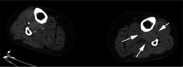 CTA images from a 63-year-old woman with COVID-19. Images through the (a) distal abdominal aorta, (b) proximal common iliac arteries, (c) external iliac arteries, (d) popliteal arteries, and (e) anterior tibial, posterior tibial, and peroneal arteries demonstrate lack of contrast opacification on the left (arrows). Hyperdensity along the periphery of the vessels in a and b corresponds to contrast rather than calcium. Note that the arrows in e point to the expected location of the vessels. (f) Oblique coronal reformatted CT image demonstrates clot at the aortic bifurcation (arrow).