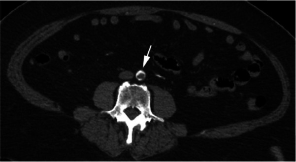 CTA images from a 63-year-old woman with COVID-19. Images through the (a) distal abdominal aorta, (b) proximal common iliac arteries, (c) external iliac arteries, (d) popliteal arteries, and (e) anterior tibial, posterior tibial, and peroneal arteries demonstrate lack of contrast opacification on the left (arrows). Hyperdensity along the periphery of the vessels in a and b corresponds to contrast rather than calcium. Note that the arrows in e point to the expected location of the vessels. (f) Oblique coronal reformatted CT image demonstrates clot at the aortic bifurcation (arrow).