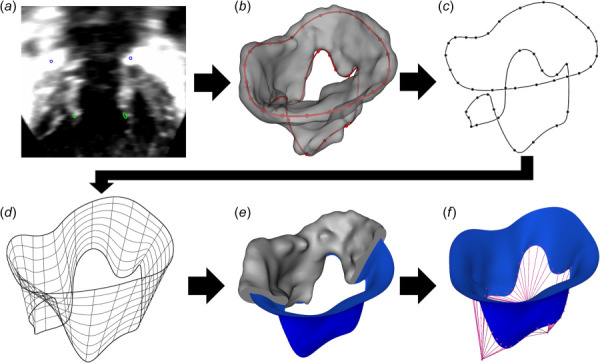 FE modeling pipeline from 3DE image, demonstrated on tricuspid valve: valve construction process from 3DE image to FE model: (a) define annulus and free edge control points (3D Slicer SlicerHeart), (b) create leaflet segmentation (SlicerHeart), (c) create splines (SlicerHeart), (d) initialize Non-Uniform Rational B-Spline (NURBS) surface (Autodesk Fusion 360), (e) adjust NURBS surface to segmentation (Fusion 360), and (f) project chordae onto leaflets (SlicerHeart). The development of leaflet medial surface extraction and NURBS editing is underway in SlicerHeart to allow all functionality in a single open-source workflow.