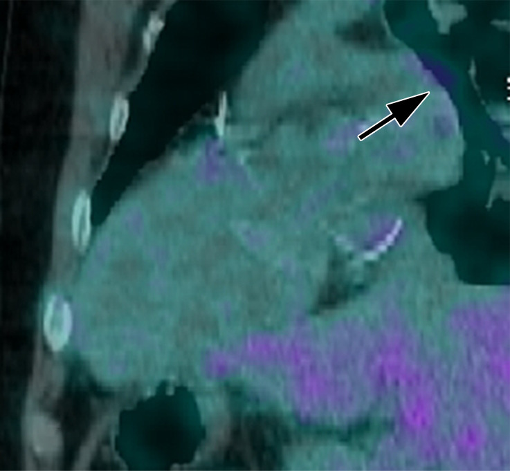 Images in a 35-year-old man with third-degree heart block and stage 1 sarcoidosis. (a) Fluorine 18 fluorodeoxyglucose (FDG)–avid myocardium (maximum standardized uptake value [SUVmax] = 7.6) in the inferior wall of the left ventricle on a two-chamber fused PET/CT image (black arrowheads). (b) This matches late gadolinium enhancement (LGE) on cardiac MR image but is more extensive (white arrowheads). (a) A large FDG-avid subcarinal lymph node (SUVmax = 6.1) (black arrow). (a, c) At follow-up after 6 months of oral corticosteroids, myocardial FDG uptake has resolved, as has uptake in the large subcarinal node (black arrow). (b, d) There is little change in LGE. Left ventricular function is mildly impaired on both studies. (b, d) A large subcarinal lymph node (white arrow) has resolved at MRI (patient 14, Table 2).