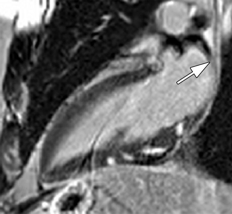 Images in a 35-year-old man with third-degree heart block and stage 1 sarcoidosis. (a) Fluorine 18 fluorodeoxyglucose (FDG)–avid myocardium (maximum standardized uptake value [SUVmax] = 7.6) in the inferior wall of the left ventricle on a two-chamber fused PET/CT image (black arrowheads). (b) This matches late gadolinium enhancement (LGE) on cardiac MR image but is more extensive (white arrowheads). (a) A large FDG-avid subcarinal lymph node (SUVmax = 6.1) (black arrow). (a, c) At follow-up after 6 months of oral corticosteroids, myocardial FDG uptake has resolved, as has uptake in the large subcarinal node (black arrow). (b, d) There is little change in LGE. Left ventricular function is mildly impaired on both studies. (b, d) A large subcarinal lymph node (white arrow) has resolved at MRI (patient 14, Table 2).