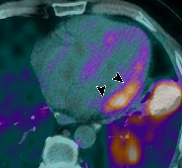 Images in a 54-year-old man with stage 2 sarcoidosis for 2 years develops new right-bundle-branch block shown on an electrocardiogram. Myocardial fluorine 18 fluorodeoxyglucose (FDG) uptake (maximum standardized uptake value [SUVmax] = 4.6) without matching late gadolinium enhancement (LGE) is shown on the (a) four-chamber fused PET/CT image (black arrowheads) and (b) cardiac MR image. With normal left ventricular (LV) function, this patient does not meet Japanese Ministry of Health and Welfare criteria but does meet Heart Rhythm Society criteria. He is treated with corticosteroids for 6 months. Follow-up PET/CT and cardiac MR images show resolution of cardiac and extracardiac FDG uptake at all sites. LGE does not develop, and LV function is unchanged. Pulmonary parenchymal disease also partly regresses at MRI (patient 24, Table 2).