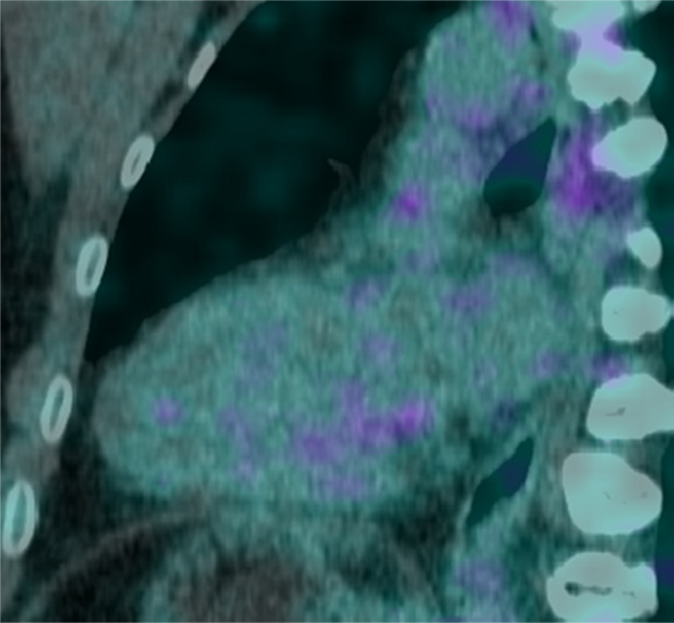 Images in a 50-year-old man with stage 2 sarcoidosis for 12 months develops resting tachycardia (100+ beats per minute). There is no myocardial tracer uptake on the (a) two-chamber fused PET/CT image, despite (b) multifocal nonischemic late gadolinium enhancement (LGE) in the anterior and inferior wall on the cardiac MR image (black arrowheads). The patient is not treated with corticosteroids and returns 6 months later. (c) There is still no myocardial fluorine 18 fluorodeoxyglucose uptake, although LGE is a little more prominent. There was no change in biventricular function or volumes (patient 7, Table 2).