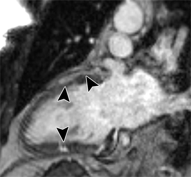 Images in a 50-year-old man with stage 2 sarcoidosis for 12 months develops resting tachycardia (100+ beats per minute). There is no myocardial tracer uptake on the (a) two-chamber fused PET/CT image, despite (b) multifocal nonischemic late gadolinium enhancement (LGE) in the anterior and inferior wall on the cardiac MR image (black arrowheads). The patient is not treated with corticosteroids and returns 6 months later. (c) There is still no myocardial fluorine 18 fluorodeoxyglucose uptake, although LGE is a little more prominent. There was no change in biventricular function or volumes (patient 7, Table 2).