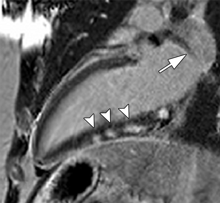 Images in a 35-year-old man with third-degree heart block and stage 1 sarcoidosis. (a) Fluorine 18 fluorodeoxyglucose (FDG)–avid myocardium (maximum standardized uptake value [SUVmax] = 7.6) in the inferior wall of the left ventricle on a two-chamber fused PET/CT image (black arrowheads). (b) This matches late gadolinium enhancement (LGE) on cardiac MR image but is more extensive (white arrowheads). (a) A large FDG-avid subcarinal lymph node (SUVmax = 6.1) (black arrow). (a, c) At follow-up after 6 months of oral corticosteroids, myocardial FDG uptake has resolved, as has uptake in the large subcarinal node (black arrow). (b, d) There is little change in LGE. Left ventricular function is mildly impaired on both studies. (b, d) A large subcarinal lymph node (white arrow) has resolved at MRI (patient 14, Table 2).