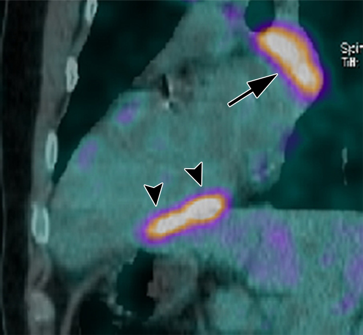 Images in a 35-year-old man with third-degree heart block and stage 1 sarcoidosis. (a) Fluorine 18 fluorodeoxyglucose (FDG)–avid myocardium (maximum standardized uptake value [SUVmax] = 7.6) in the inferior wall of the left ventricle on a two-chamber fused PET/CT image (black arrowheads). (b) This matches late gadolinium enhancement (LGE) on cardiac MR image but is more extensive (white arrowheads). (a) A large FDG-avid subcarinal lymph node (SUVmax = 6.1) (black arrow). (a, c) At follow-up after 6 months of oral corticosteroids, myocardial FDG uptake has resolved, as has uptake in the large subcarinal node (black arrow). (b, d) There is little change in LGE. Left ventricular function is mildly impaired on both studies. (b, d) A large subcarinal lymph node (white arrow) has resolved at MRI (patient 14, Table 2).