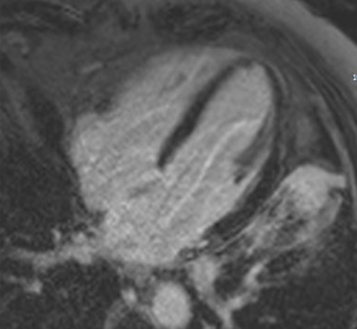 Images in a 54-year-old man with stage 2 sarcoidosis for 2 years develops new right-bundle-branch block shown on an electrocardiogram. Myocardial fluorine 18 fluorodeoxyglucose (FDG) uptake (maximum standardized uptake value [SUVmax] = 4.6) without matching late gadolinium enhancement (LGE) is shown on the (a) four-chamber fused PET/CT image (black arrowheads) and (b) cardiac MR image. With normal left ventricular (LV) function, this patient does not meet Japanese Ministry of Health and Welfare criteria but does meet Heart Rhythm Society criteria. He is treated with corticosteroids for 6 months. Follow-up PET/CT and cardiac MR images show resolution of cardiac and extracardiac FDG uptake at all sites. LGE does not develop, and LV function is unchanged. Pulmonary parenchymal disease also partly regresses at MRI (patient 24, Table 2).