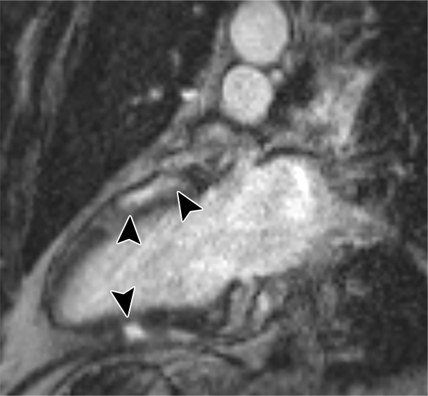 Images in a 50-year-old man with stage 2 sarcoidosis for 12 months develops resting tachycardia (100+ beats per minute). There is no myocardial tracer uptake on the (a) two-chamber fused PET/CT image, despite (b) multifocal nonischemic late gadolinium enhancement (LGE) in the anterior and inferior wall on the cardiac MR image (black arrowheads). The patient is not treated with corticosteroids and returns 6 months later. (c) There is still no myocardial fluorine 18 fluorodeoxyglucose uptake, although LGE is a little more prominent. There was no change in biventricular function or volumes (patient 7, Table 2).