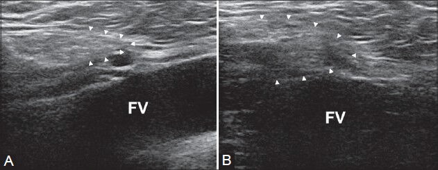 Figure 11 (A, B)