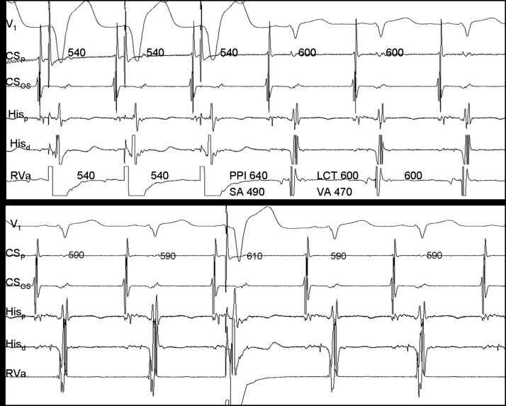 Long RP interval tachycardia. What is the mechanism? - PMC