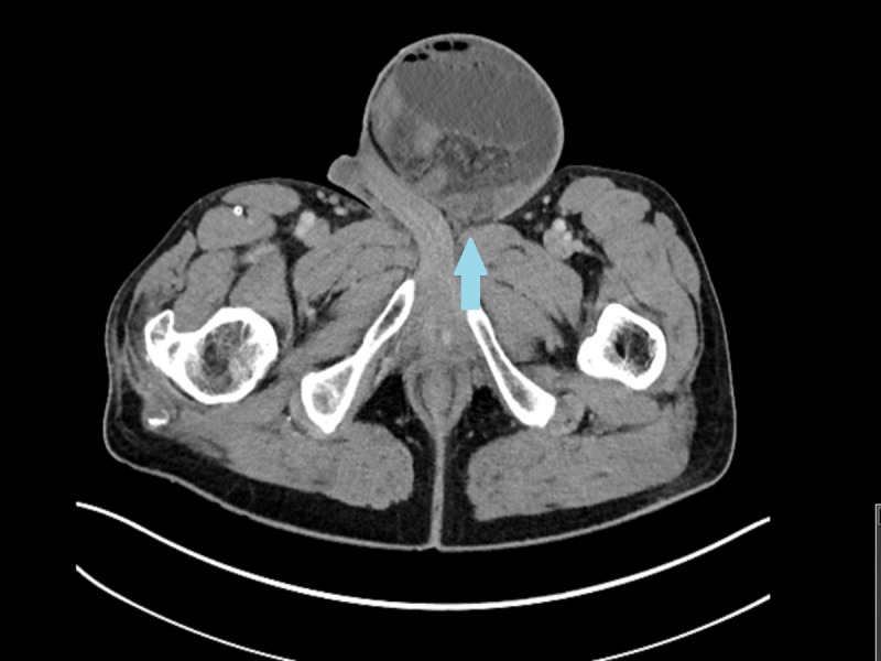 Hernioscopy in Incarcerated Inguinal Hernia Spontaneously Reduced after ...